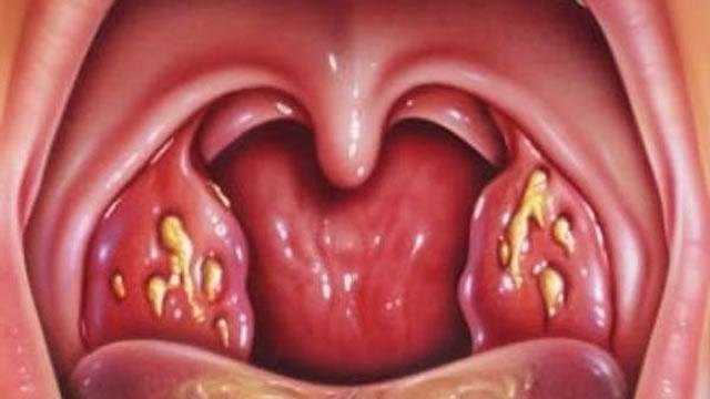 Необычные иммунные клетки предотвращают молочницу полости рта
